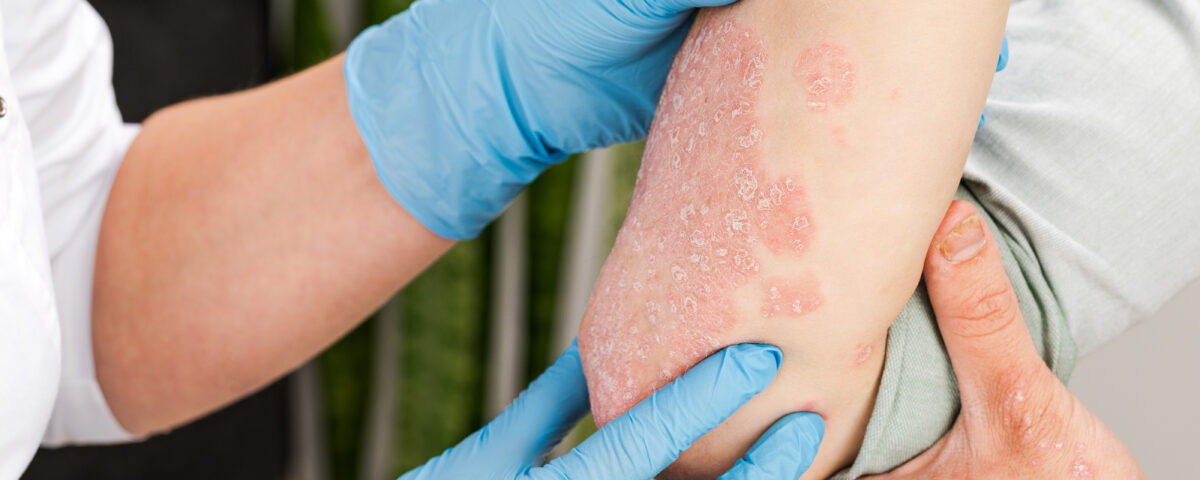 psoriasis clinical trial