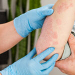 psoriasis clinical trial