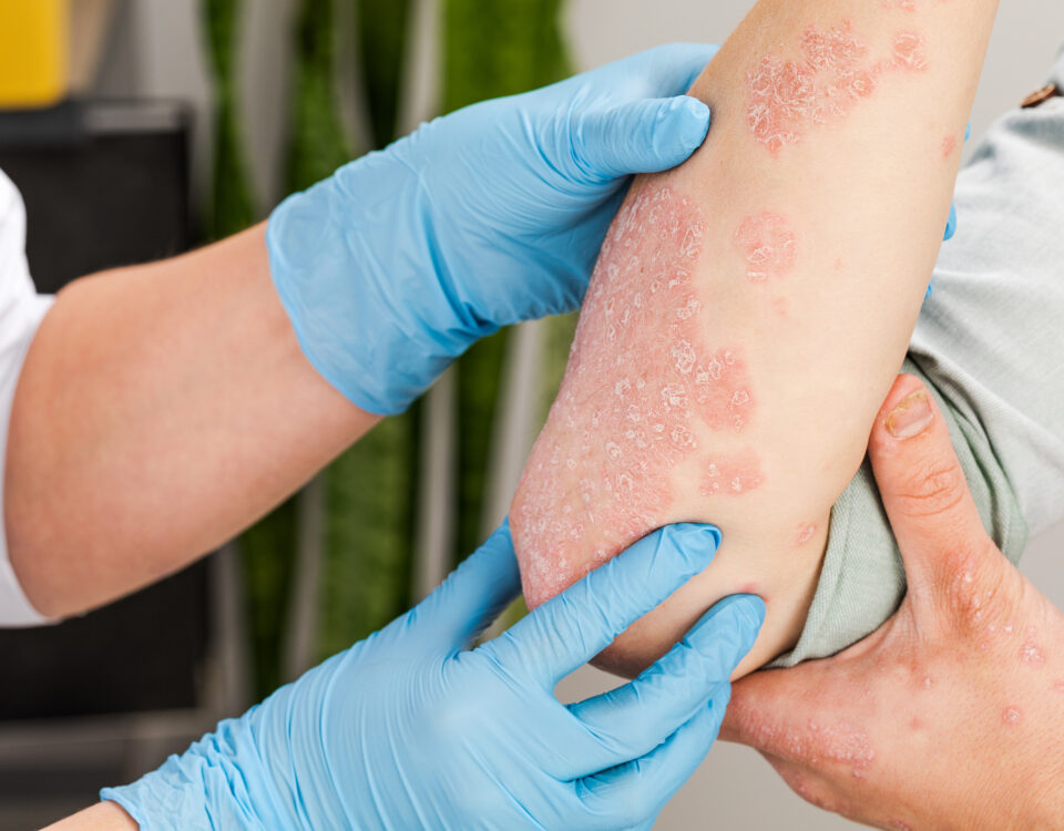 psoriasis clinical trial